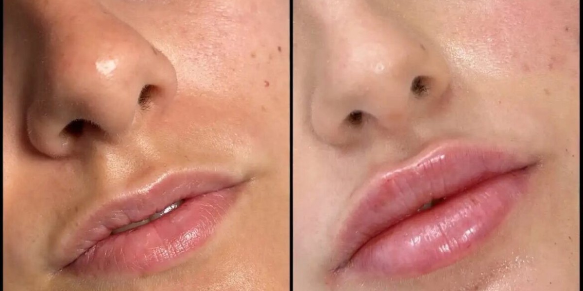 Fillers Treatments in Dubai for a Fresh and Radiant Appearance