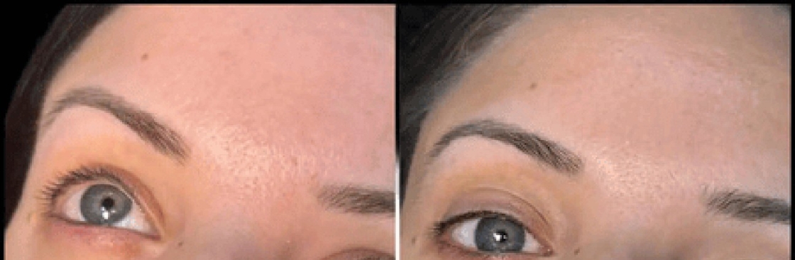 dermal fillers Cover Image