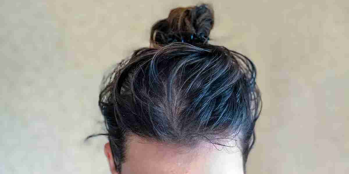 Oily Scalp and Hair Loss: Understanding the Connection and Protecting Your Hair Naturally