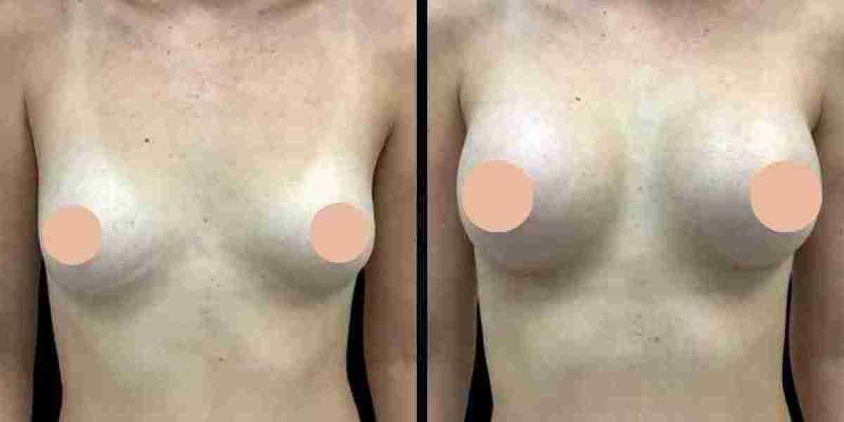 Consultation with Best Breast Augmentation Surgeons in Dubai