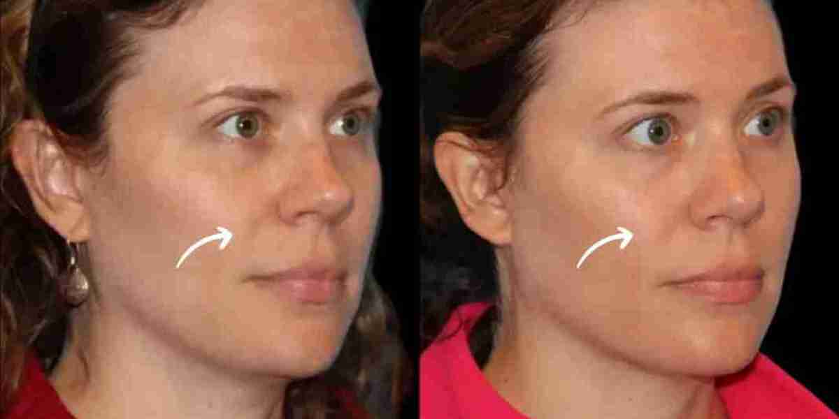 Sculptra Treatment in Dubai for Delicate Contours
