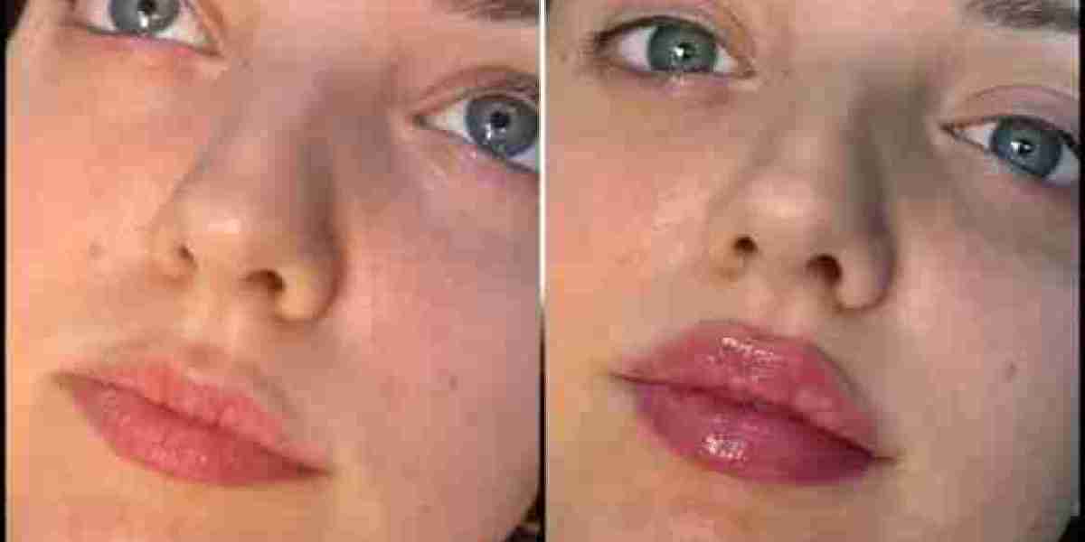 Fillers Treatment in Dubai for Safe Facial Volume Restoration
