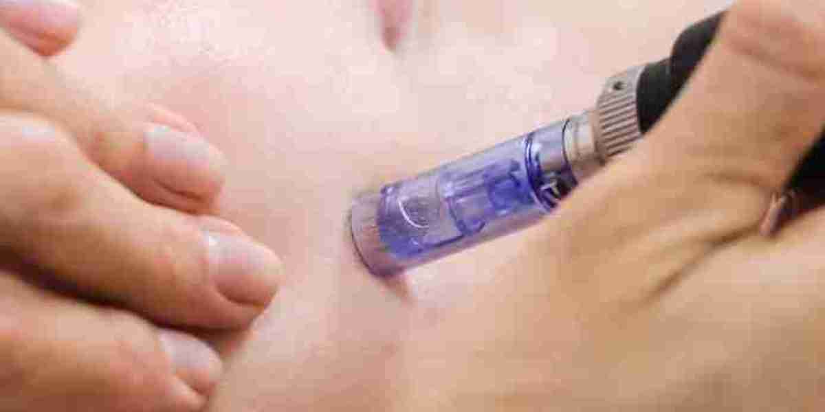 Microneedling In Manchester: Professional Skin Rejuvenation with Lasting Results