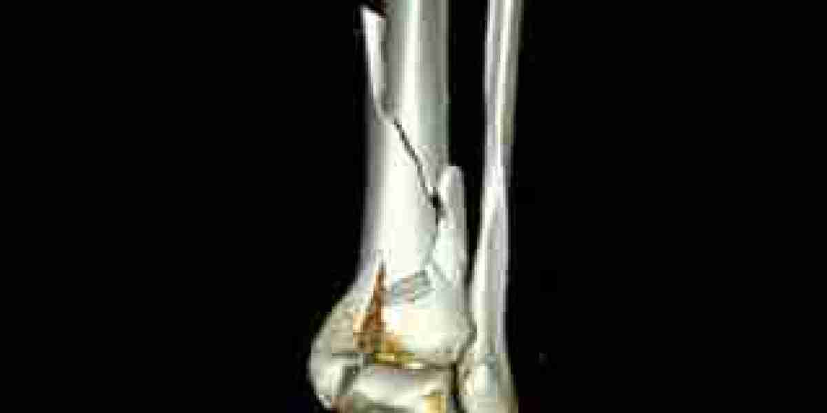 Private Fracture Treatment London: Specialist Care for Broken Bones and Trauma
