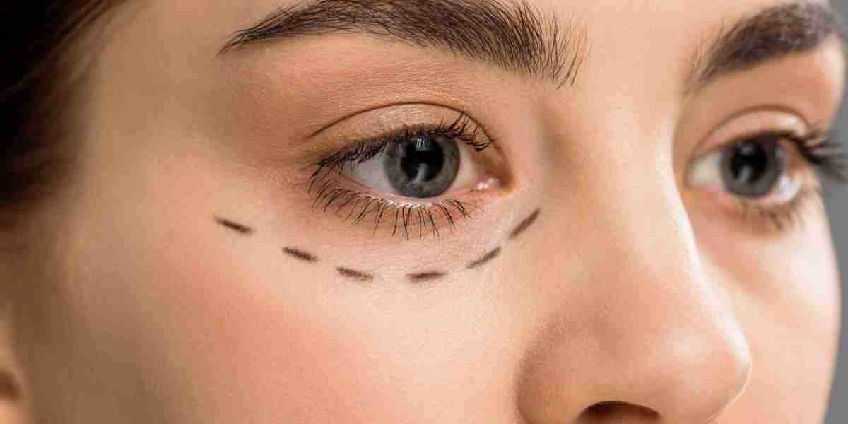 Upper Eyelid Surgery in London: What to Expect at Your Consultation
