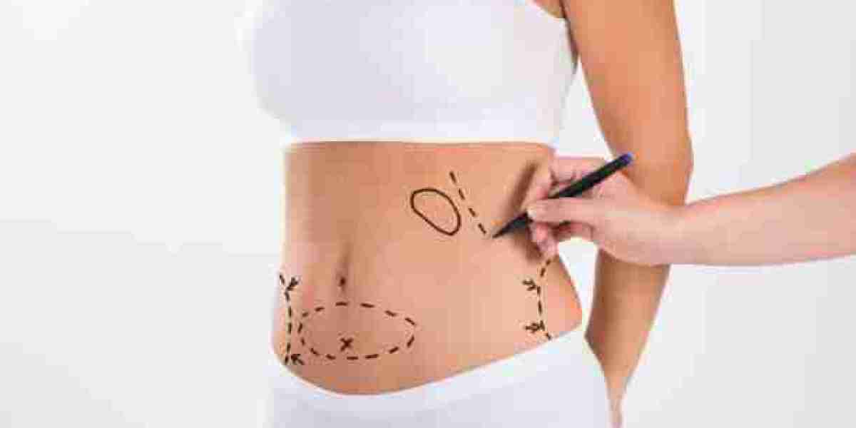 Liposuction Treatment Considerations for Individual Body Types