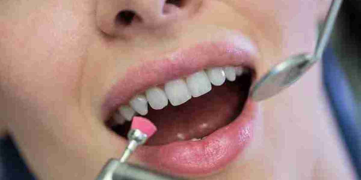 What to Expect Before, During, and After Teeth Whitening in Rockville, MD