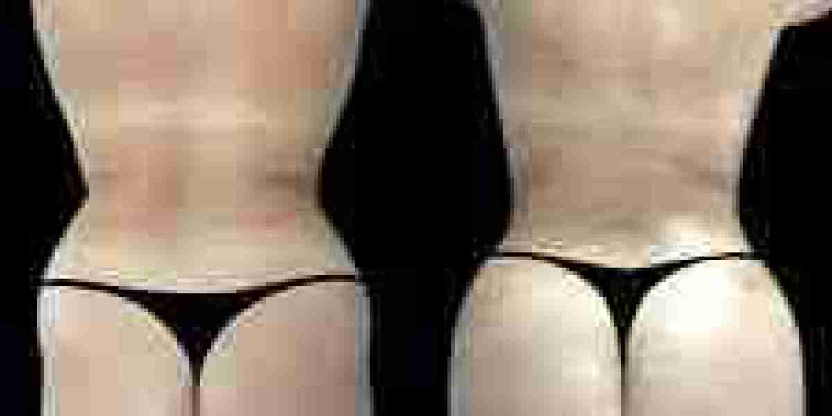 Butt Fat Transfer Surgery in Dubai: What to Know About Anesthesia Options