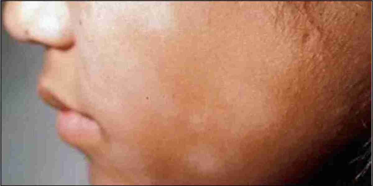 Vitiligo Specialist Doctor and Vitiligo Treatment in India